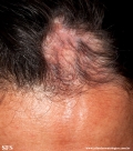 scleroderma-frontoparietal_morphoea