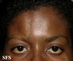 scleroderma-frontoparietal_morphoea