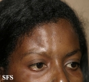 scleroderma-frontoparietal_morphoea