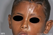 scleroderma-frontoparietal_morphoea