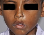 scleroderma-frontoparietal_morphoea