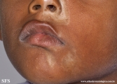 scleroderma-frontoparietal_morphoea