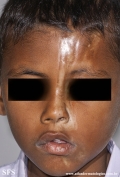 scleroderma-frontoparietal_morphoea