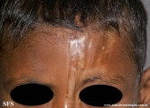 scleroderma-frontoparietal_morphoea