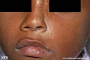 scleroderma-frontoparietal_morphoea