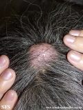 trichilemmal cyst