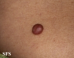 trichilemmal cyst