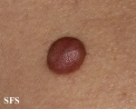 trichilemmal cyst