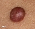 trichilemmal cyst
