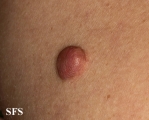 trichilemmal cyst
