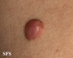 trichilemmal cyst