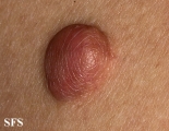 trichilemmal cyst