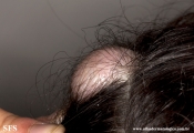 trichilemmal cyst