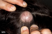 trichilemmal cyst