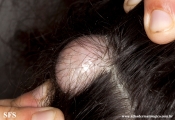 trichilemmal cyst