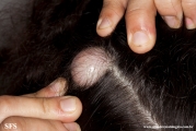 trichilemmal cyst