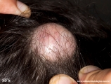 trichilemmal cyst