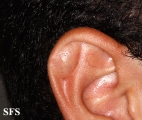 pseudocyst of the ear