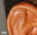 pseudocyst of the ear