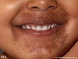 childhood granulomatous periorificial dermatites