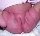 diaper dermatitis