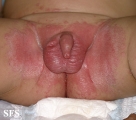 diaper dermatitis