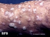 lichen planus verrucosus