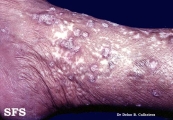 lichen planus verrucosus