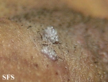 condyloma acuminatum