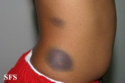 leukemia