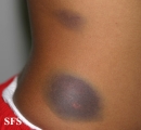 leukemia
