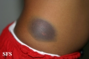 leukemia