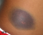 leukemia
