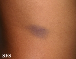 leukemia