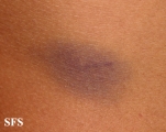 leukemia