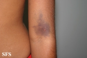 leukemia