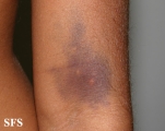 leukemia