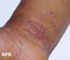 scabies-secondary infection