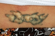 fat herniation-after laser