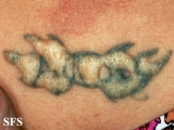 fat herniation-after laser