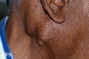 parotid_carcinoma