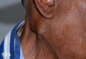 parotid_carcinoma
