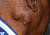 parotid_carcinoma