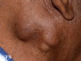 parotid_carcinoma
