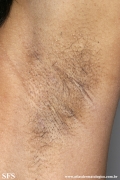 fox-fordyce disease