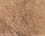 fox-fordyce disease