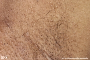 fox-fordyce disease