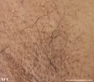 fox-fordyce disease