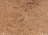 fox-fordyce disease