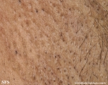 fox-fordyce disease